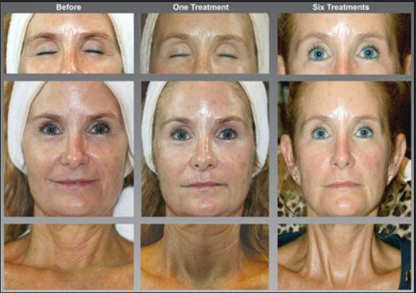 SWiCH Dermal Revitalization Treatment | Circadia Skin Care